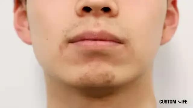 レーザー脱毛から1週間後(鼻下・あご)