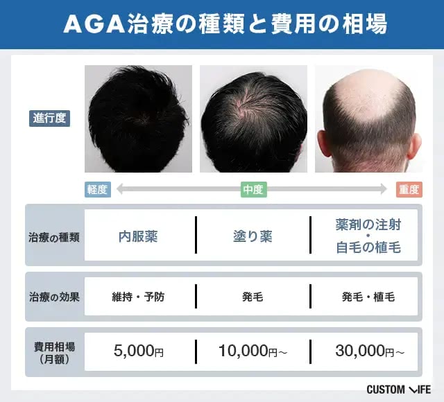 AGA治療の費用相場
