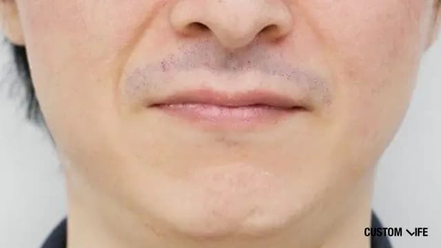 16回目の脱毛直後のヒゲ