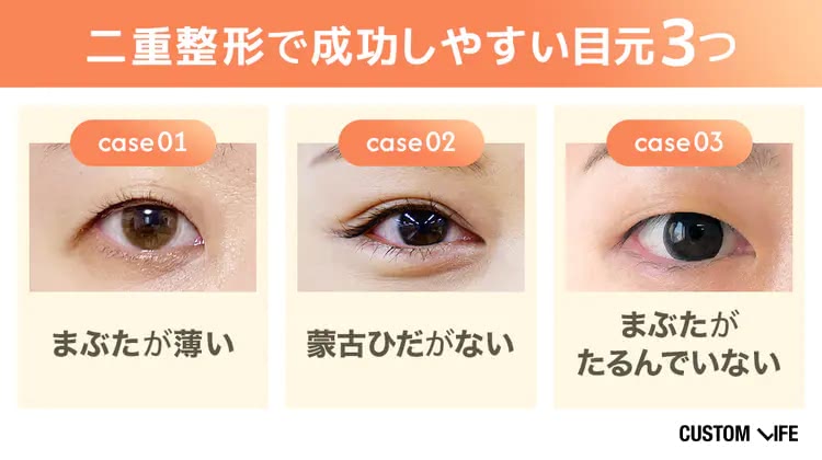 二重整形が成功しやすい目元を解説