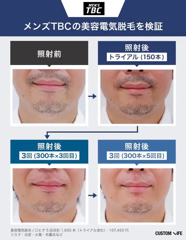 メンズYBCの脱毛効果を編集部員が実際に受けて検証