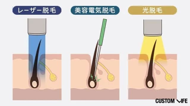 レーザー脱毛、美容電気脱毛、サロン脱毛の違いをイラストで解説