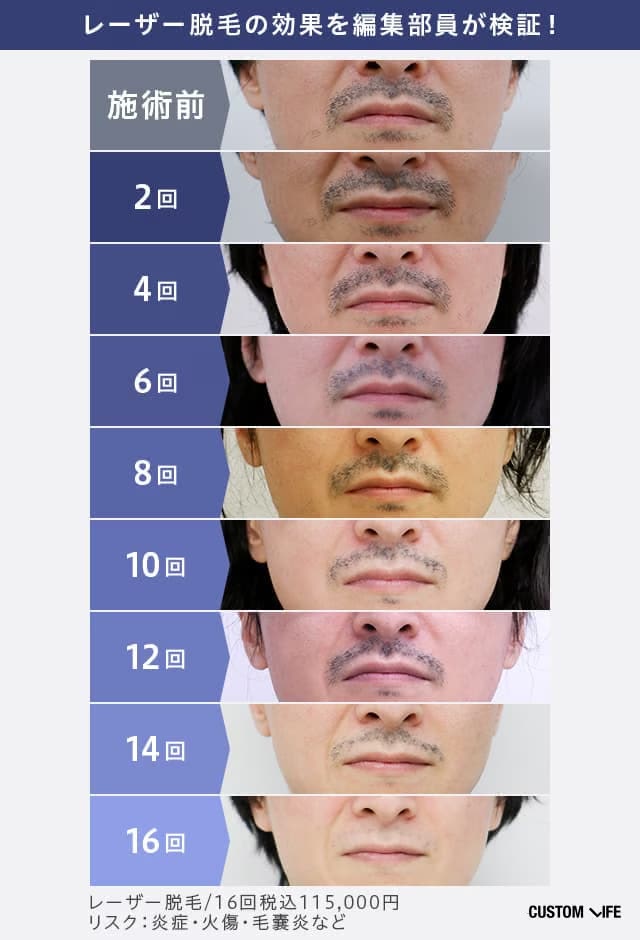合計16回の医療脱毛を受けた編集部員のヒゲを比較