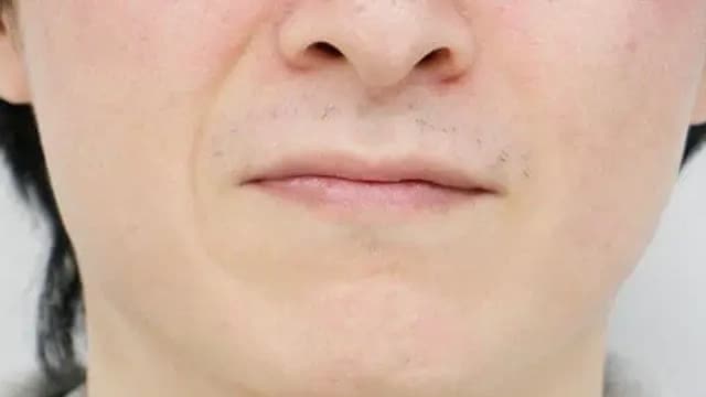 16回目の脱毛から1か月経過したヒゲ