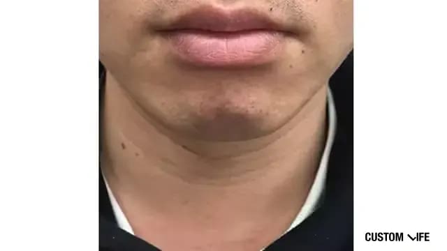 メンズリゼであごを脱毛した人5回目