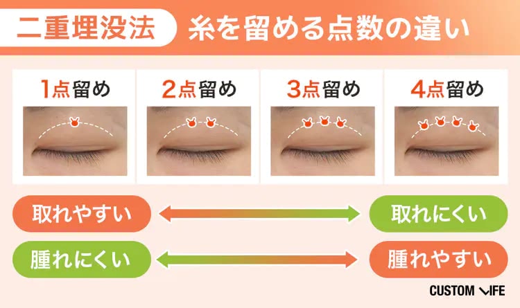 埋没法の糸の留め方について解説する図
