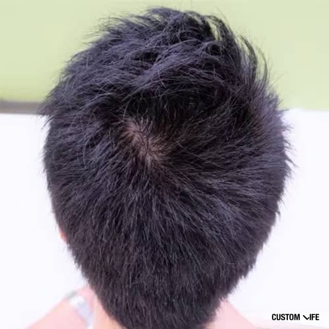 正常なつむじの画像