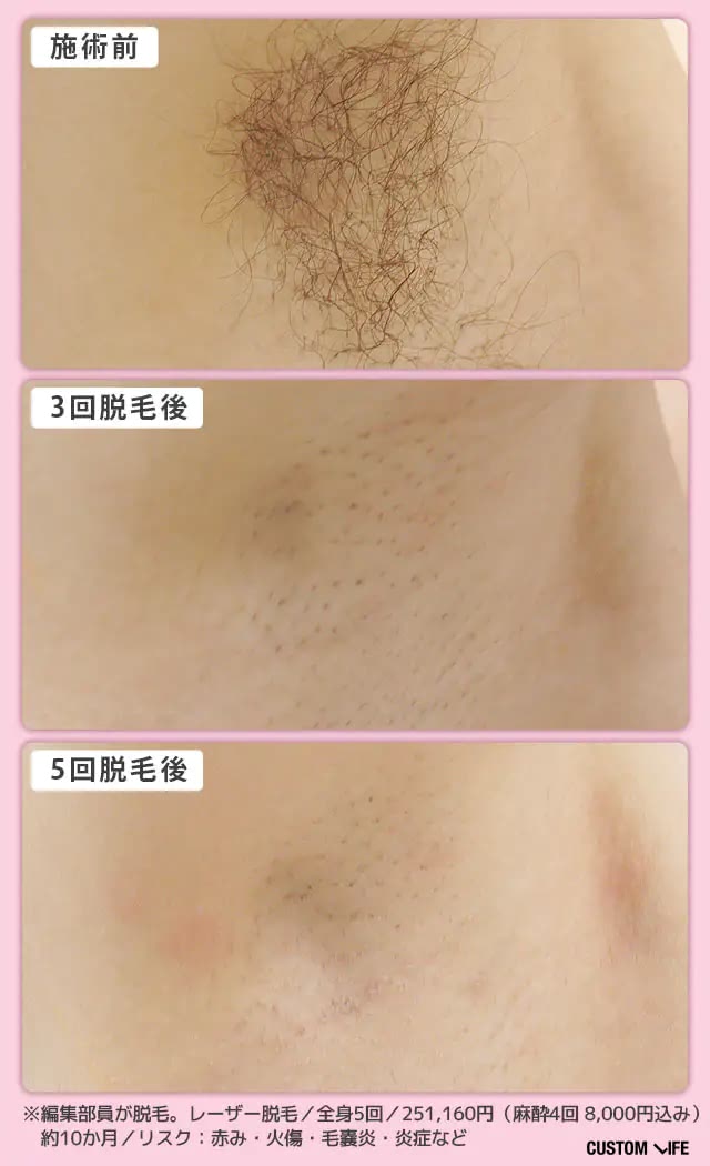 脇脱毛の検証画像