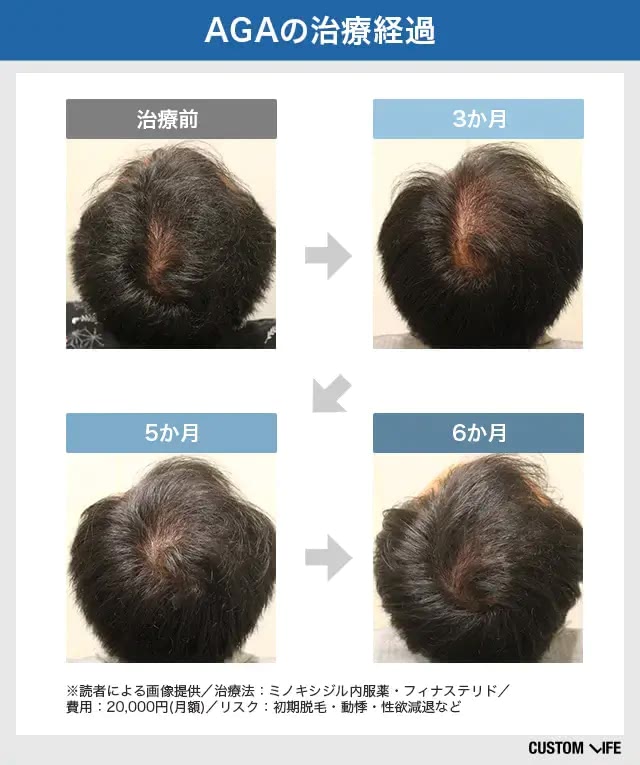 AGA治療の効果を写真で解説