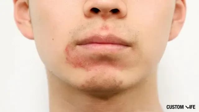 レーザー脱毛から1日後(鼻下・あご)