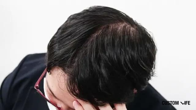 初期脱毛に悩む男性