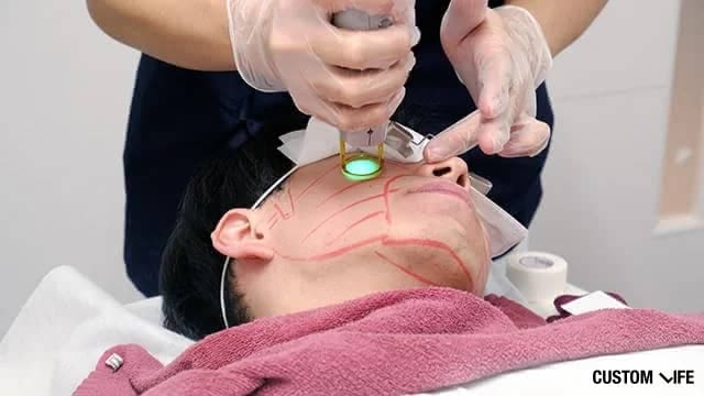 メンズリゼでヒゲ脱毛を体験する編集部員