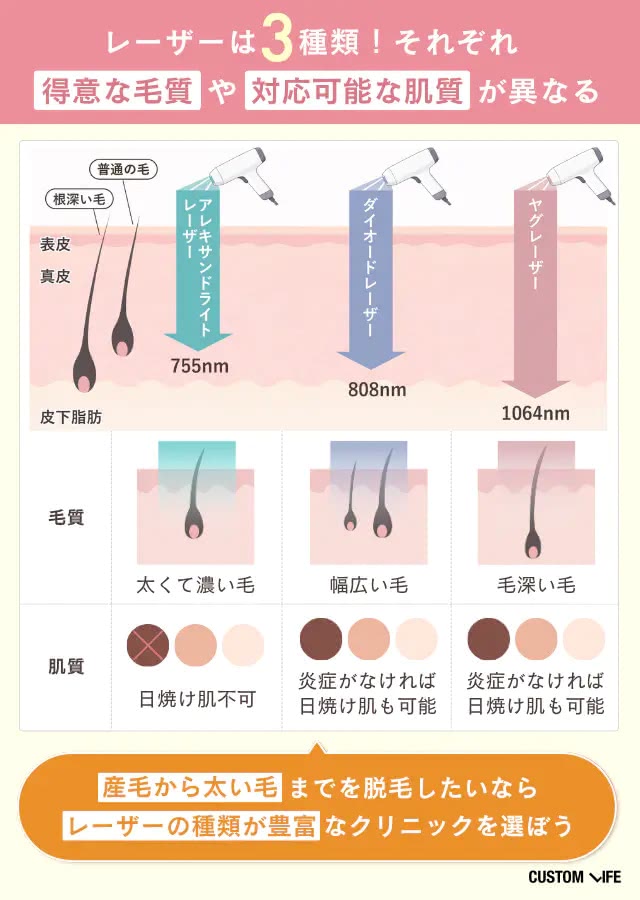 医療脱毛クリニックの選び方②レーザー