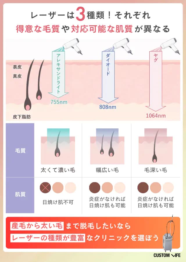 医療脱毛クリニックの選び方②レーザー