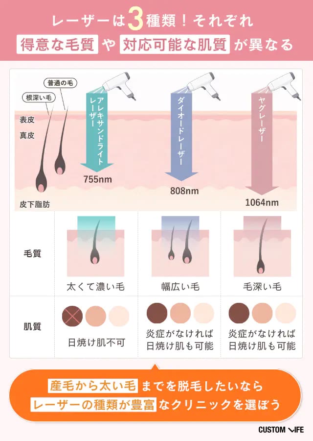 医療脱毛クリニックの選び方②レーザー