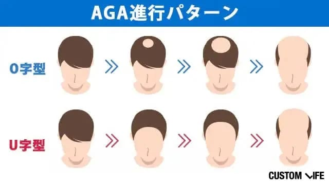 AGA進行パターン