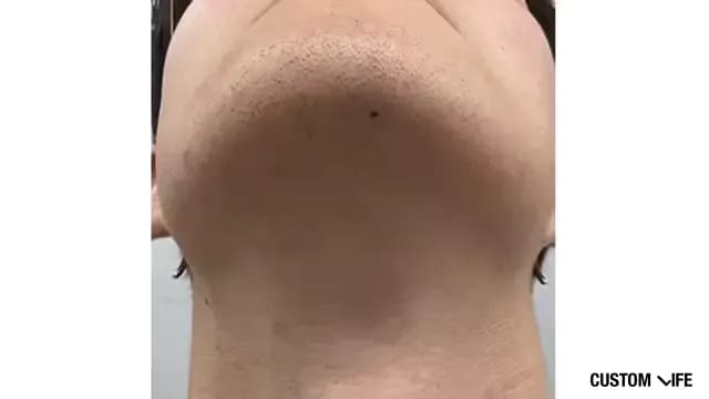 メンズリゼであご下を脱毛した人5回目