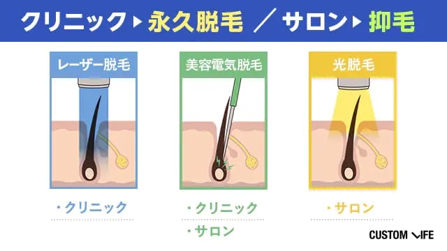 脱毛法の違いを解説するイラスト