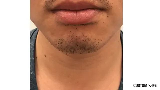 メンズリゼであごを脱毛した人1回目
