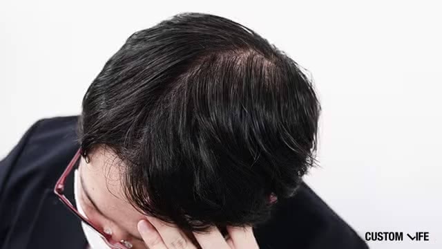 ミノキシジルの副作用がつらい男性