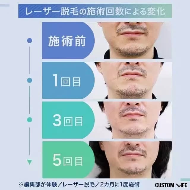 医療レーザー脱毛によるヒゲの変化