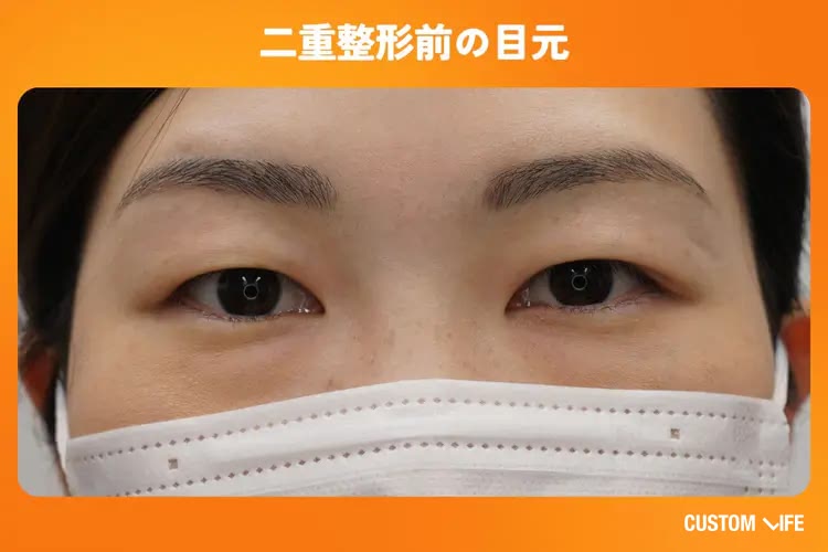 二重整形をする前の目元