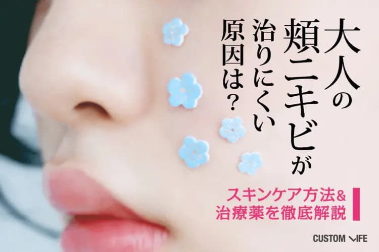 大人の頬ニキビが治りにくい原因は？スキンケア方法＆治療薬を徹底解説
