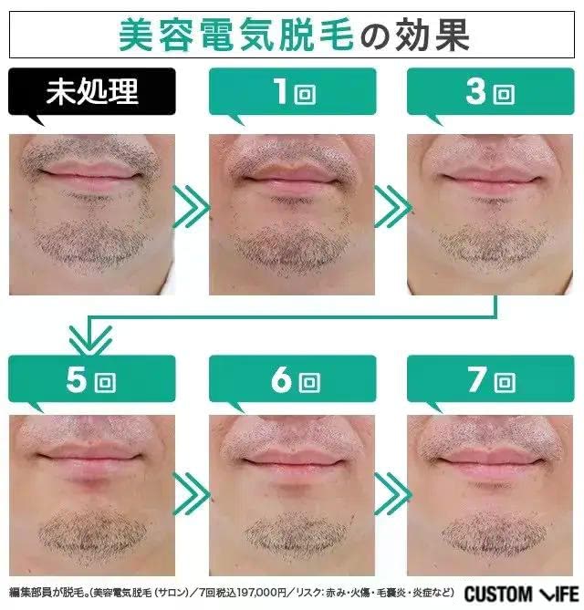 編集部員が実際に体験した美容電気脱毛のヒゲ脱毛10回目までのビフォーアフター