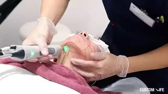 メンズリゼで右あごをレーザー脱毛中