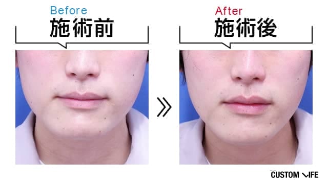 施術前後のお肌の様子