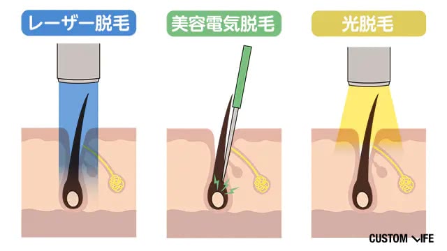 3つの脱毛方法