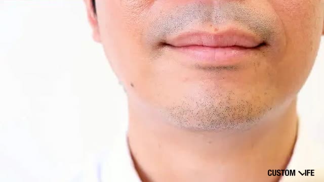 ヒゲ脱毛痛い