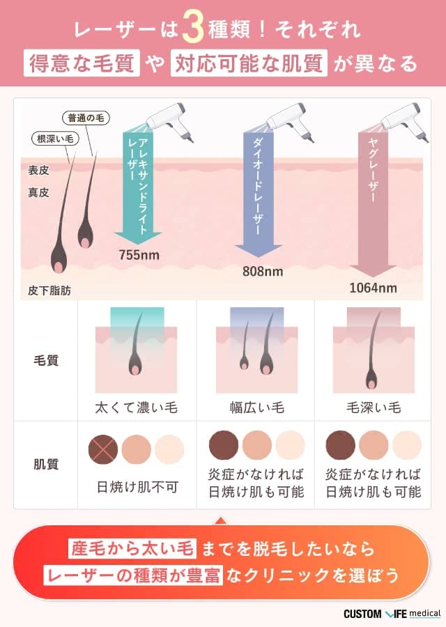 大阪の医療脱毛の選び方（レーザー）