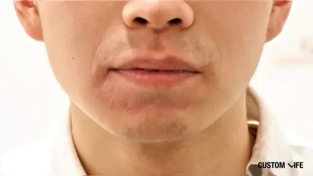 レーザー脱毛前(鼻下・あご)