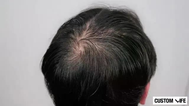 薄毛が気になる男性のつむじ・頭頂部