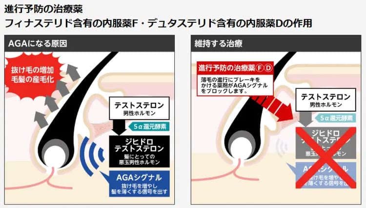 フィナステリド／デュタステリドの効果