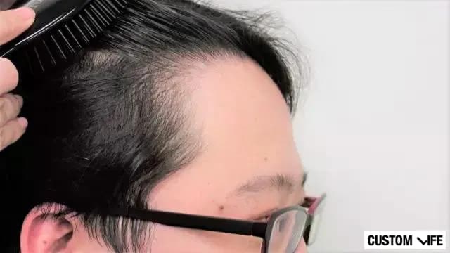 薄毛が気になる男性の生え際