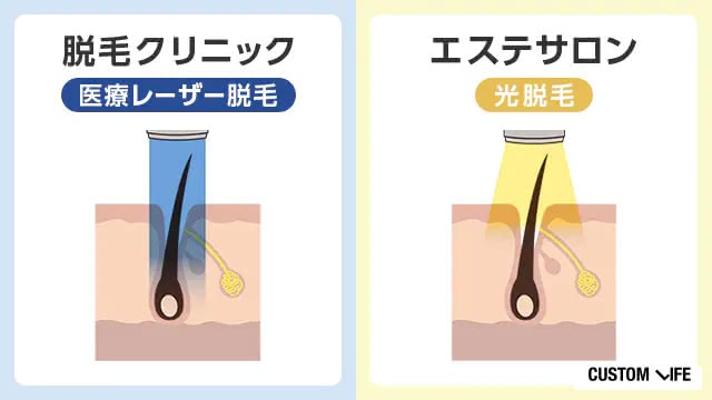 クリニックとサロンの違い比較すると永久脱毛ができるのは「医療脱毛」で減耗ができるのは「美容脱毛」