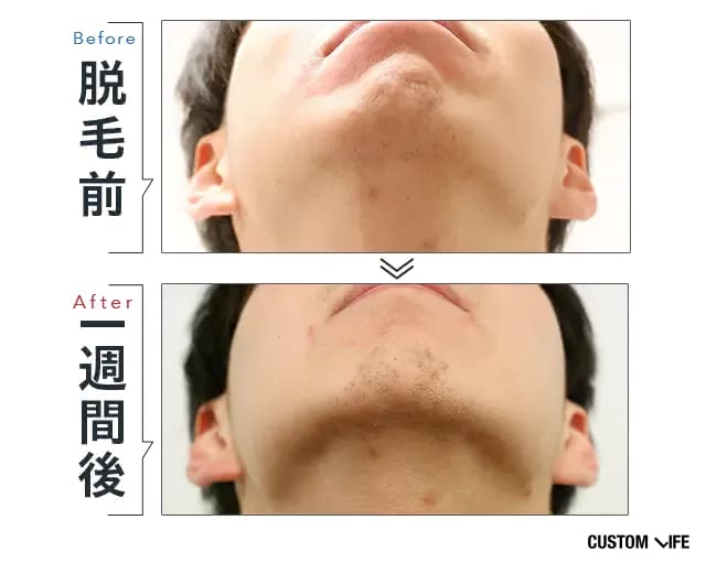 メンズリゼで脱毛したあご下ビフォーアフター