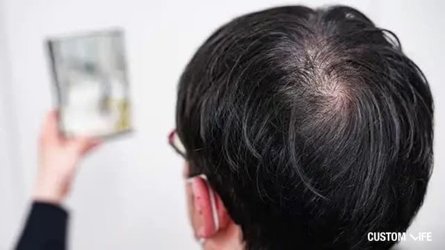AGA・薄毛に悩む男性