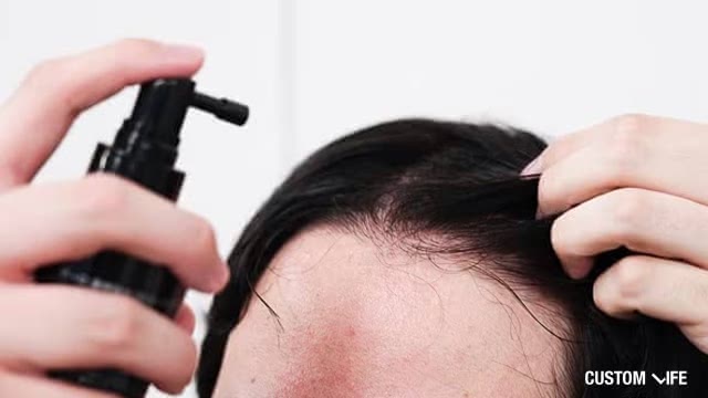 育毛剤を使用する薄毛の男性