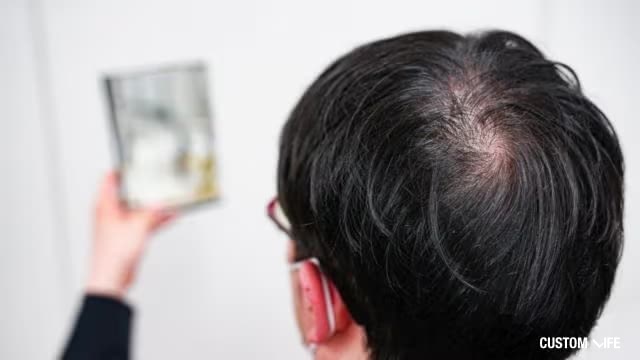 AGA・薄毛に悩む男性