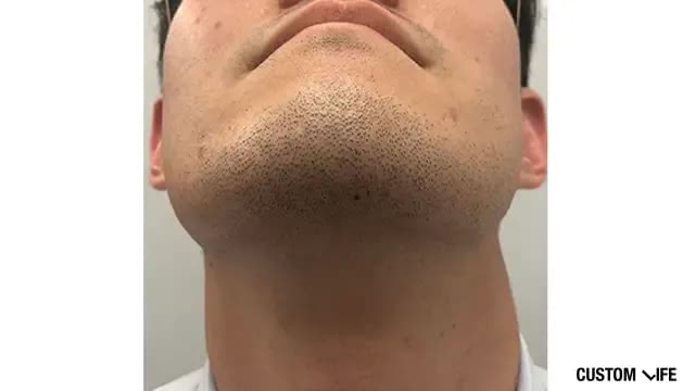 メンズリゼであご下を脱毛した人ビフォー