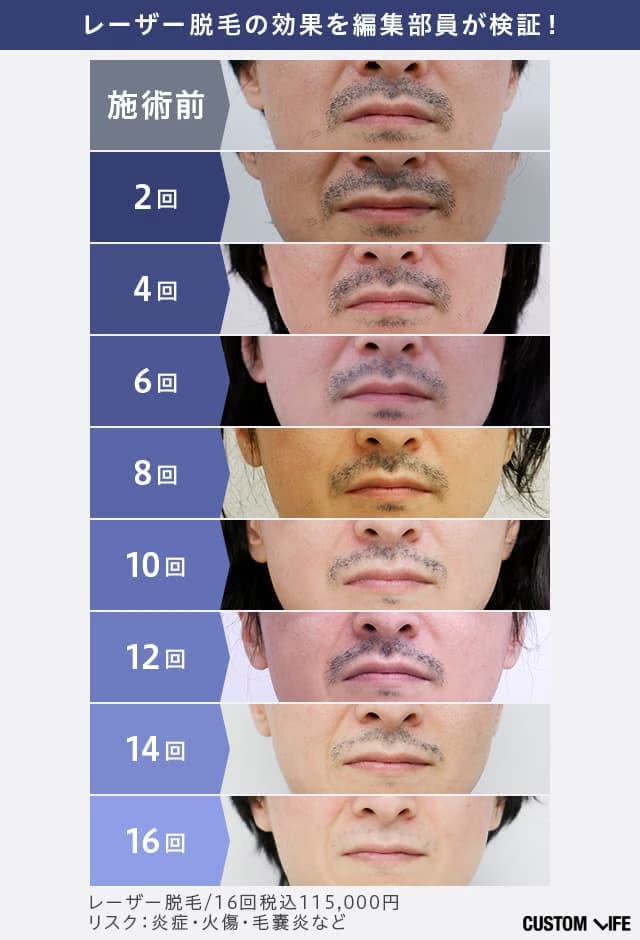 合計16回の医療脱毛を受けた編集部員のヒゲ