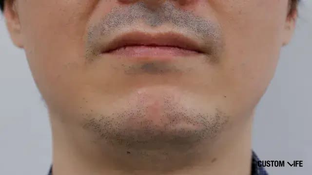 ヒゲ脱毛前のシェービング目安