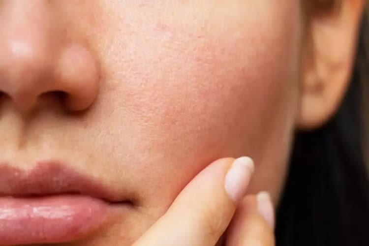 敏感肌の赤みを治すには？顔の赤みの原因から改善方法まで徹底解説