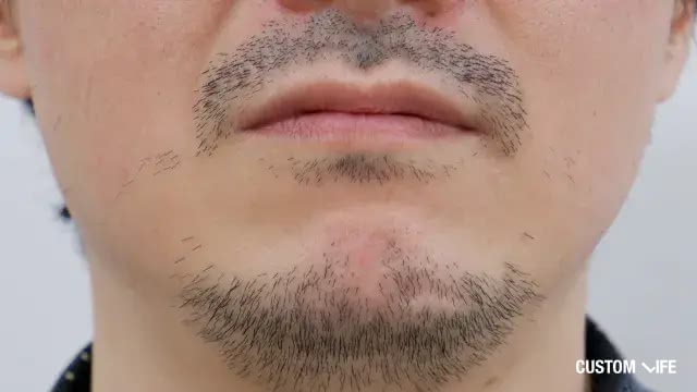 ヒゲ脱毛前の悪いヒゲの状態例