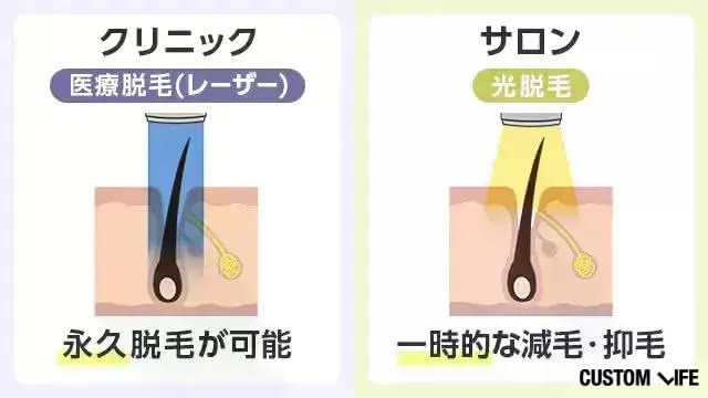 医療脱毛はレーザー照射して永久脱毛し、美容脱毛は光を照射して減耗抑毛する
