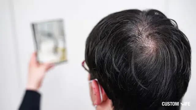 AGA・薄毛に悩む男性