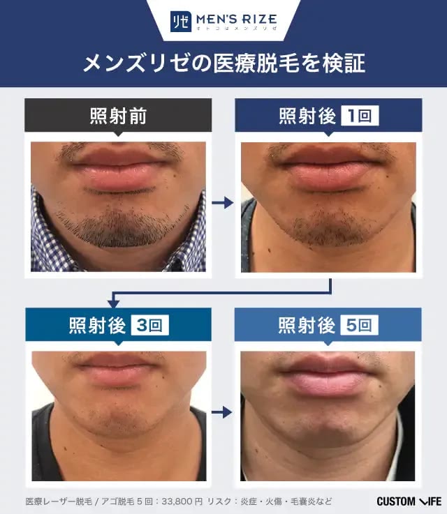 メンズリゼの脱毛効果を編集部員が実際に受けて検証